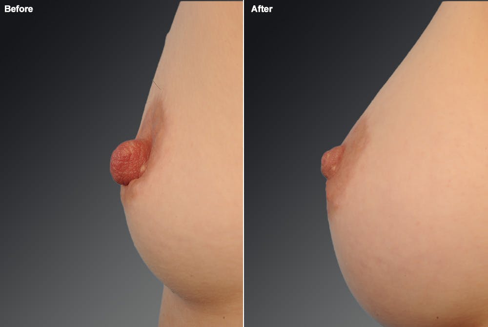 Nipple Reduction Before & After Gallery - Patient 108616976 - Image 1