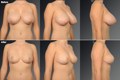 Breast Reduction Before & After Gallery - Patient 108673642 - Image 1