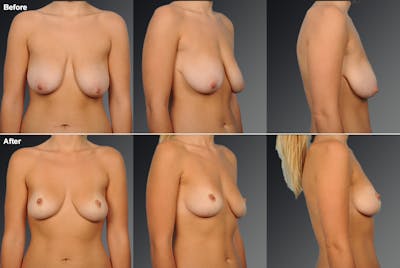 Breast Lift (Mastopexy) Before & After Gallery - Patient 108673699 - Image 1