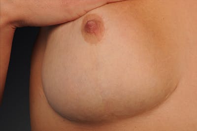 Breast Scar Closeups Before & After Gallery - Patient 108616984 - Image 1