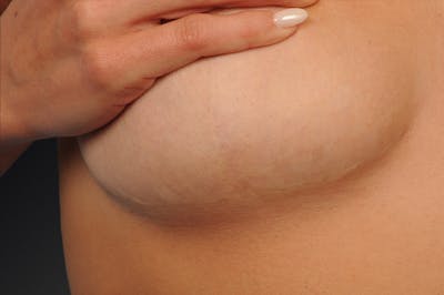 Breast Scar Closeups Before & After Gallery - Patient 108616985 - Image 1