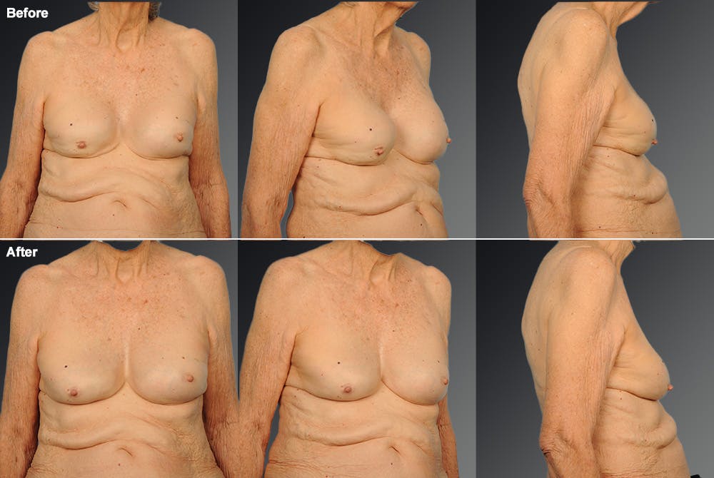 Breast Implant Revision Before & After Gallery - Patient 105554765 - Image 1