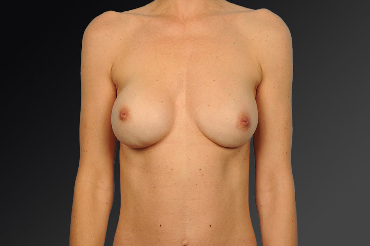 Breast Implant Revision Before & After Gallery - Patient 108616946 - Image 1