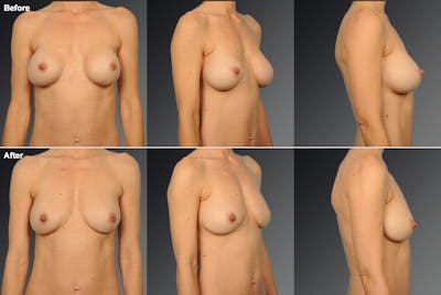 Breast Implant Revision Before & After Gallery - Patient 108616948 - Image 1