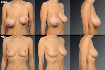 Breast Reduction Before & After Gallery - Patient 108673631 - Image 1