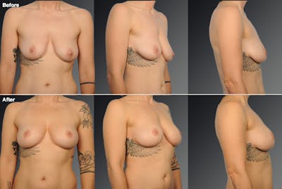 Breast Lift (Mastopexy) Before & After Gallery - Patient 108673700 - Image 1