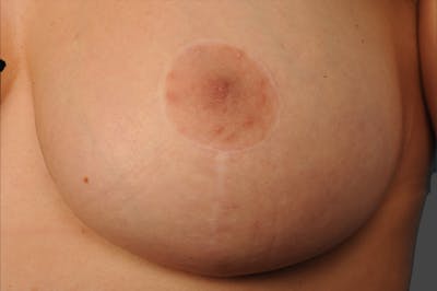 Breast Scar Closeups Before & After Gallery - Patient 108616983 - Image 1