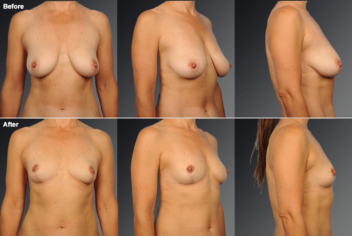 Breast Reduction Before & After Gallery - Patient 108673623 - Image 1