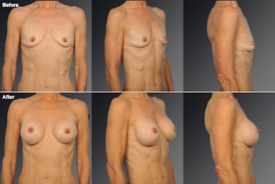 Breast Augmentation before & after
