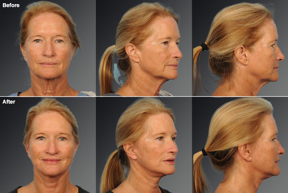 Face and Neck Lift Before & After Gallery - Patient 108676468 - Image 1