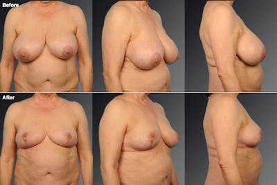 Breast Reduction Before & After Gallery - Patient 108673641 - Image 1