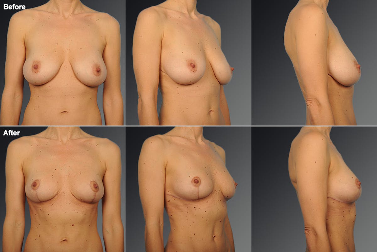 Breast Reduction Before & After Gallery - Patient 116789543 - Image 1