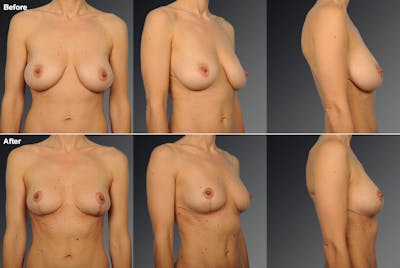 Breast Reduction Before & After Gallery - Patient 116789543 - Image 1
