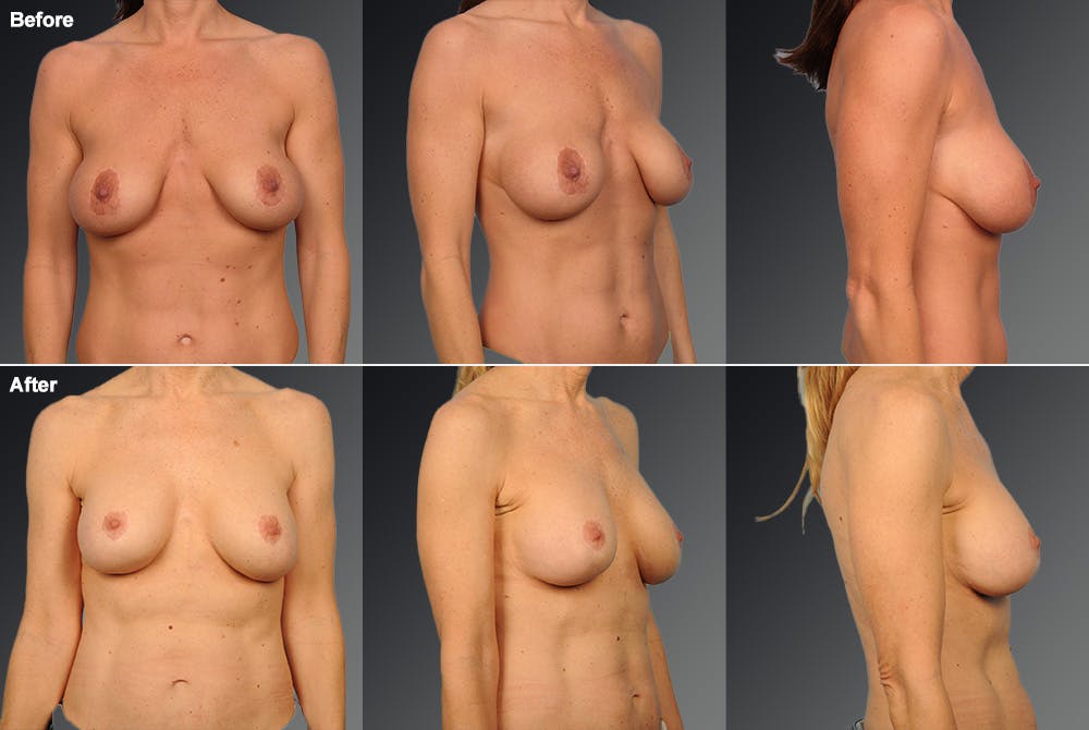 Breast Implant Revision Before & After Gallery - Patient 116789551 - Image 1
