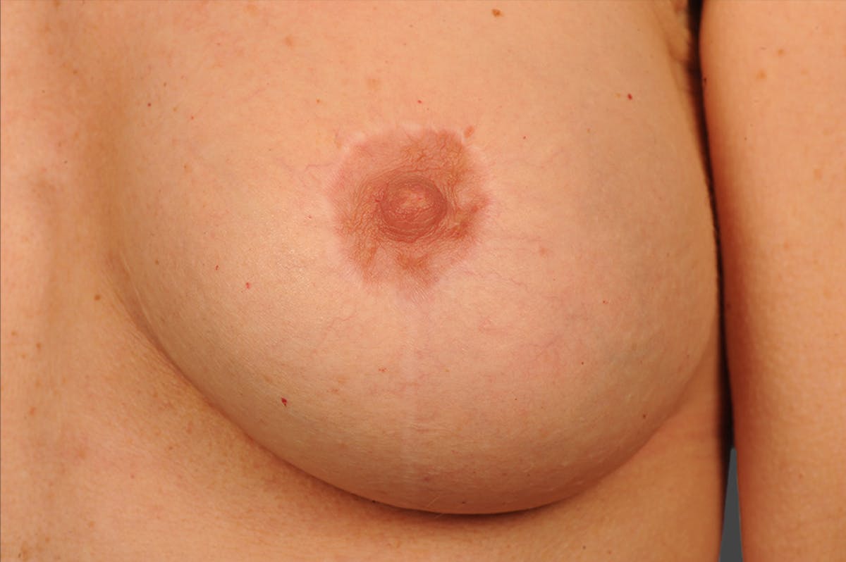 Breast Scar Closeups Before & After Gallery - Patient 116789554 - Image 1