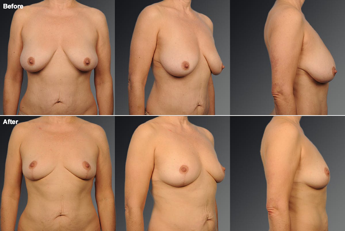 Breast Reduction Before & After Gallery - Patient 116789558 - Image 1