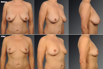 Breast Reduction Before & After Gallery - Patient 116789558 - Image 1