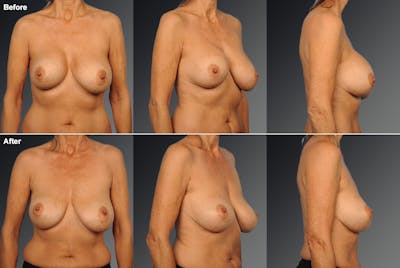 Breast Implant Revision Before & After Gallery - Patient 116789562 - Image 1