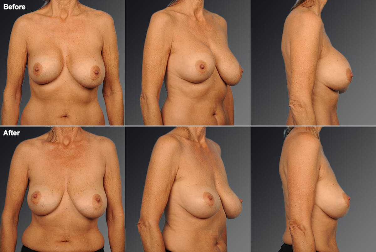 Breast Implant Revision Before & After Gallery - Patient 116789562 - Image 1
