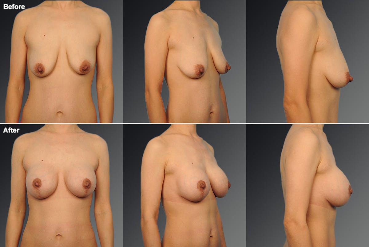 Breast Augmentation with Anchor Lift Before & After Gallery - Patient 116789569 - Image 1