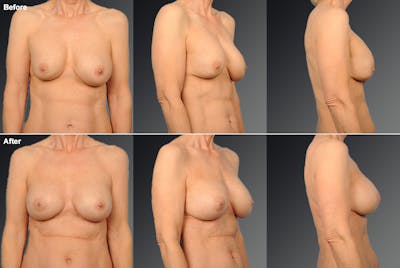 Breast Implant Revision Before & After Gallery - Patient 116789593 - Image 1