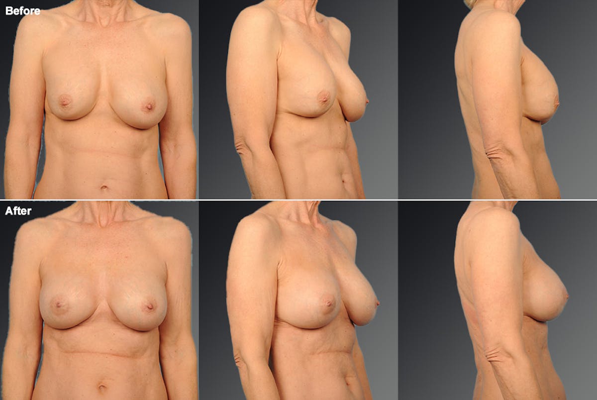 Breast Implant Revision Before & After Gallery - Patient 116789593 - Image 1