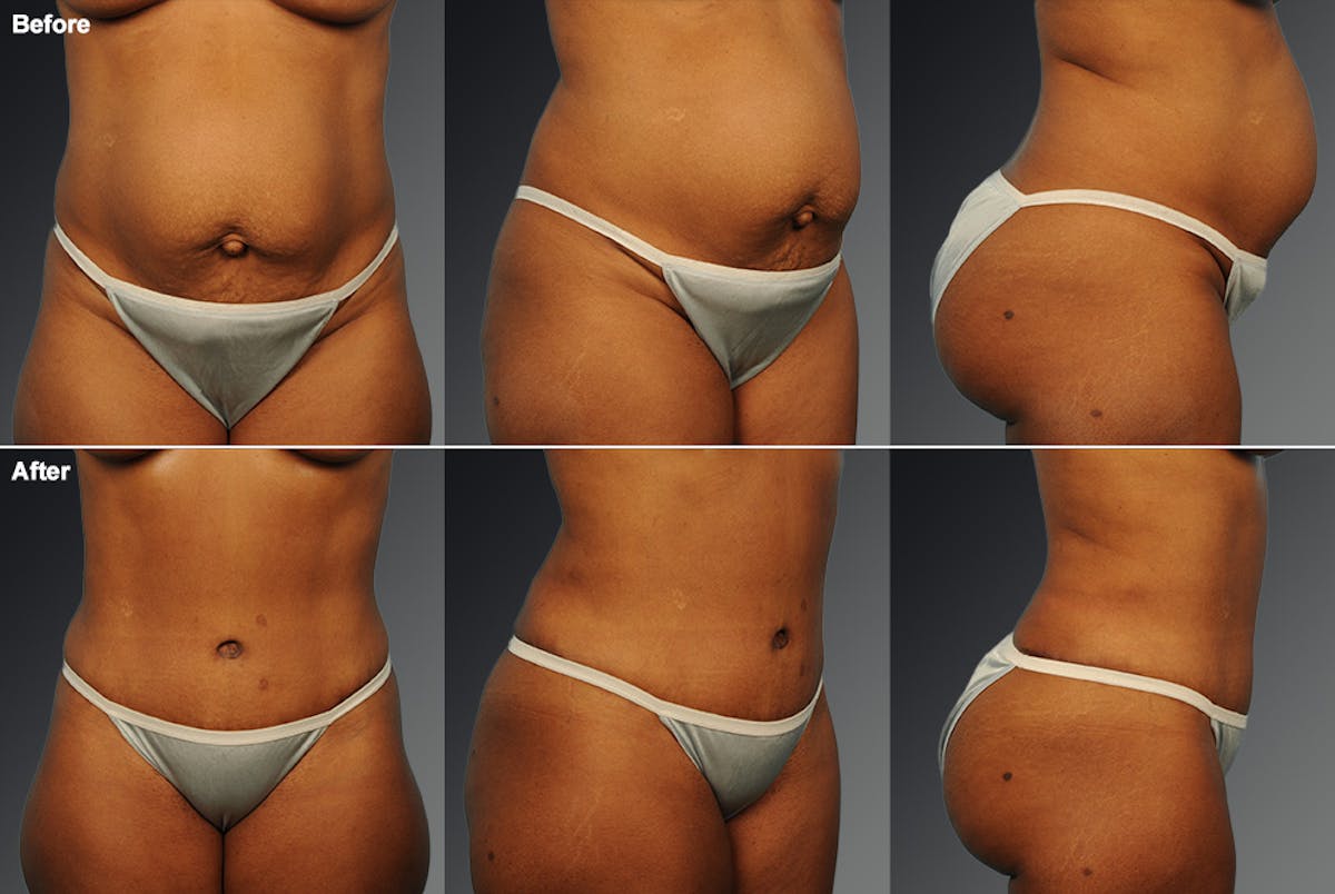 Tummy Tuck Before & After Gallery - Patient 116798056 - Image 1