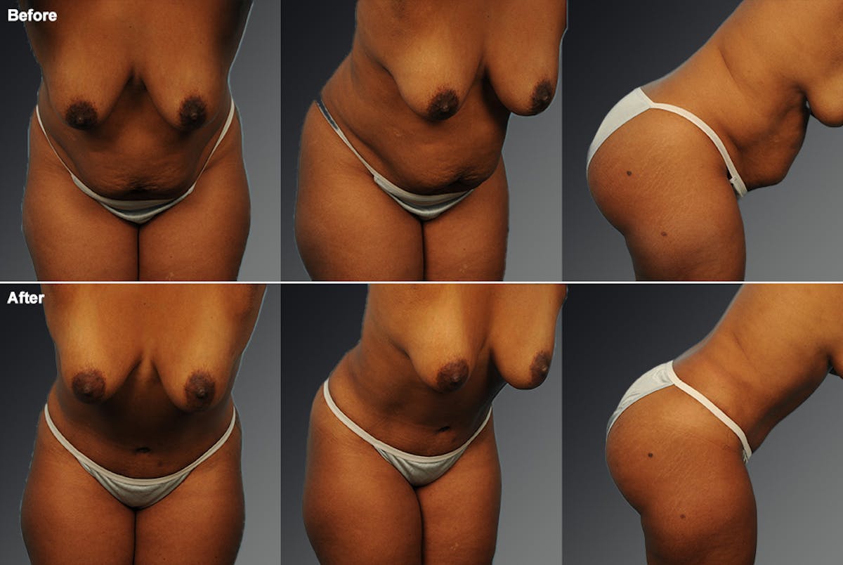 Tummy Tuck Before & After Gallery - Patient 116789609 - Image 1