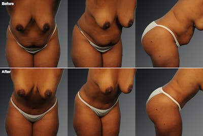 Tummy Tuck Before & After Gallery - Patient 116789609 - Image 1