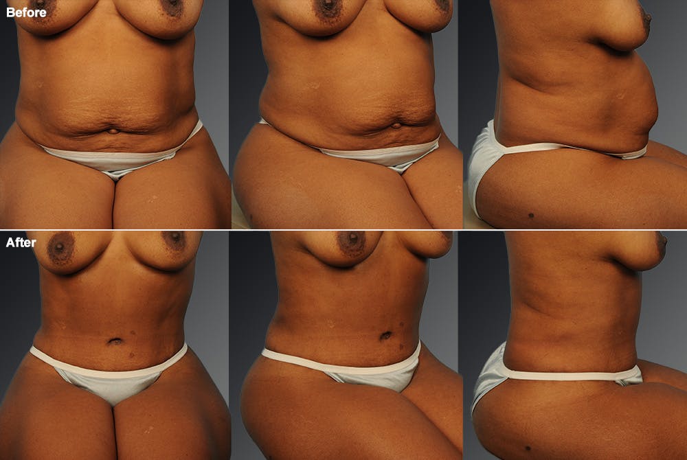 Tummy Tuck Before & After Gallery - Patient 116789610 - Image 1