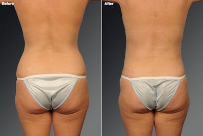 Liposuction Before & After Gallery - Patient 116798066 - Image 1