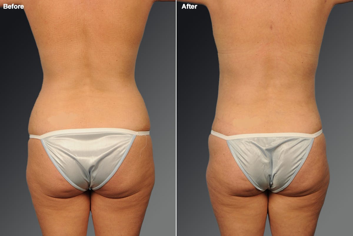 Liposuction Before & After Gallery - Patient 116798066 - Image 1