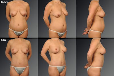 Mommy Makeover Before & After Gallery - Patient 116798058 - Image 1