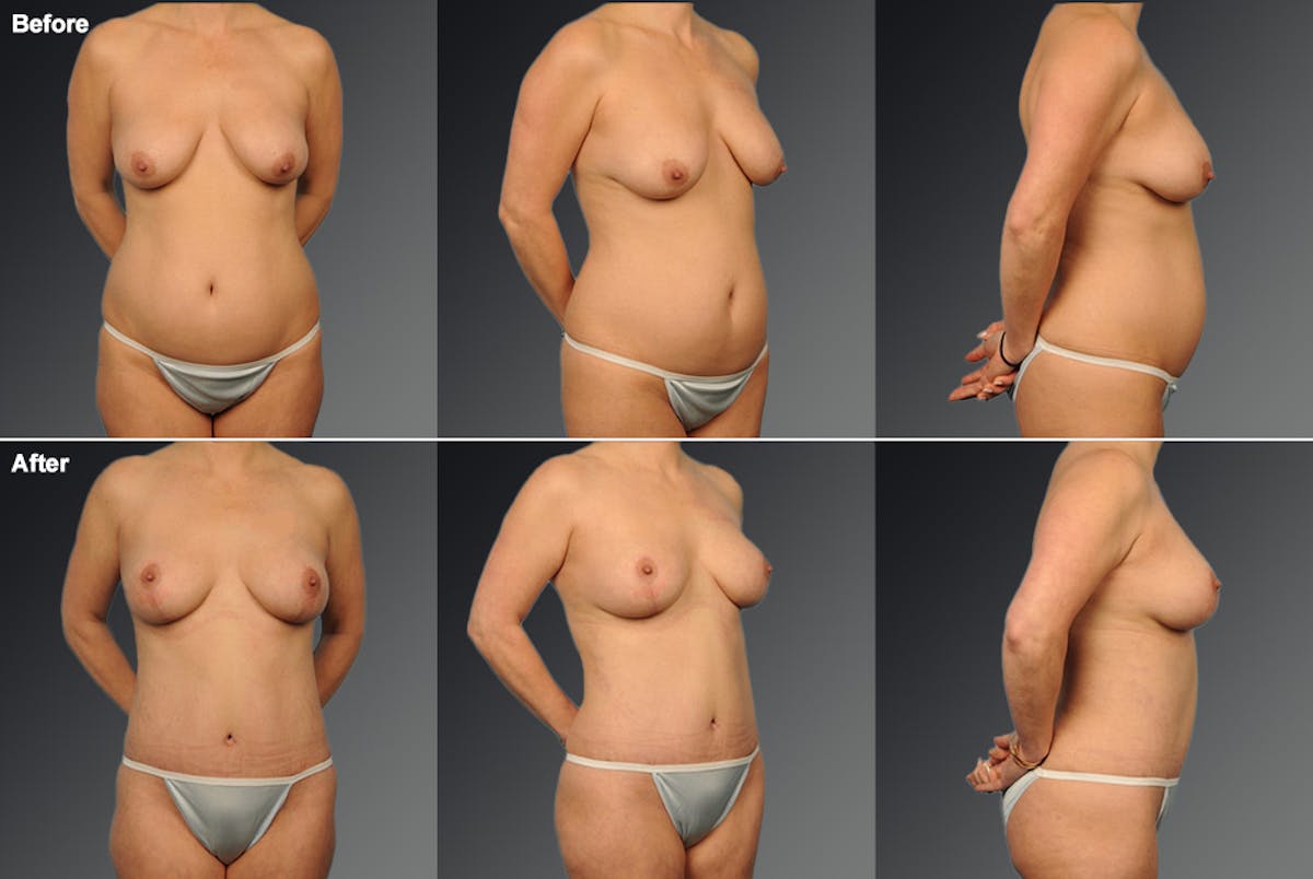 Mommy Makeover Before & After Gallery - Patient 116798058 - Image 1