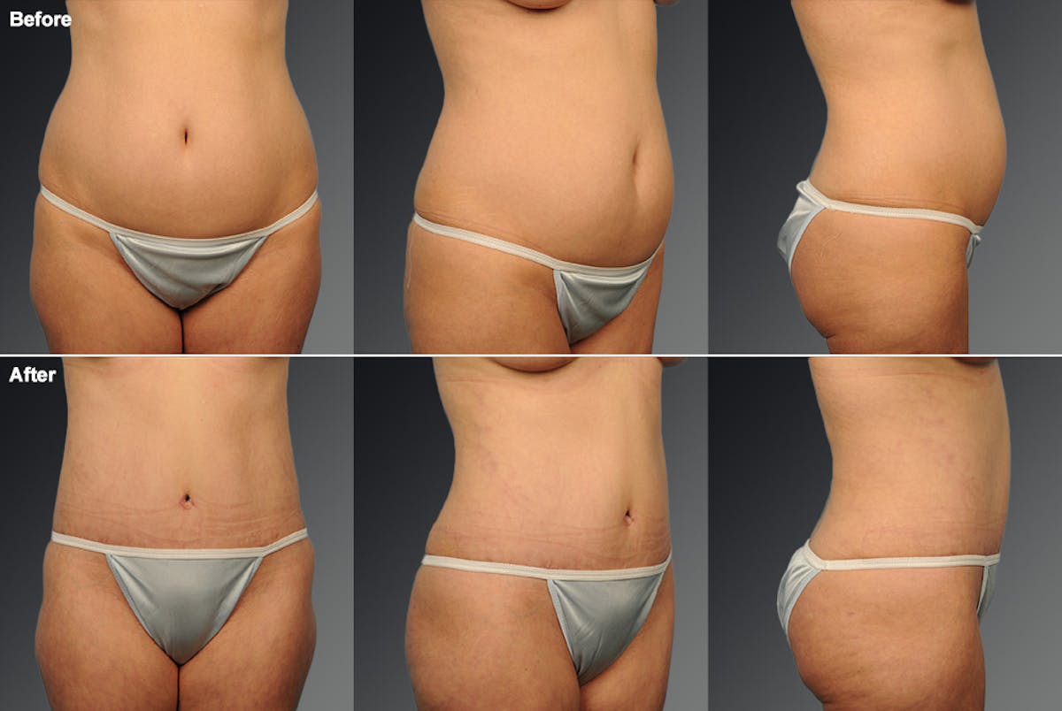 Tummy Tuck Before & After Gallery - Patient 116798055 - Image 1