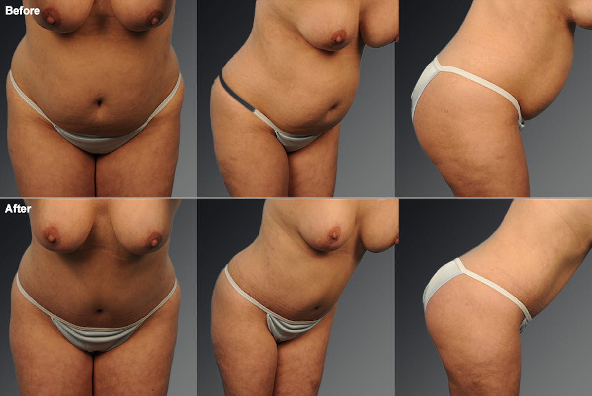 Tummy Tuck Before & After Gallery - Patient 116798054 - Image 1