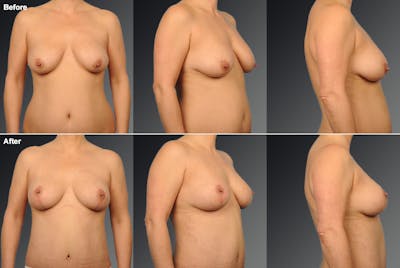 Breast Lift (Mastopexy) Before & After Gallery - Patient 116798063 - Image 1