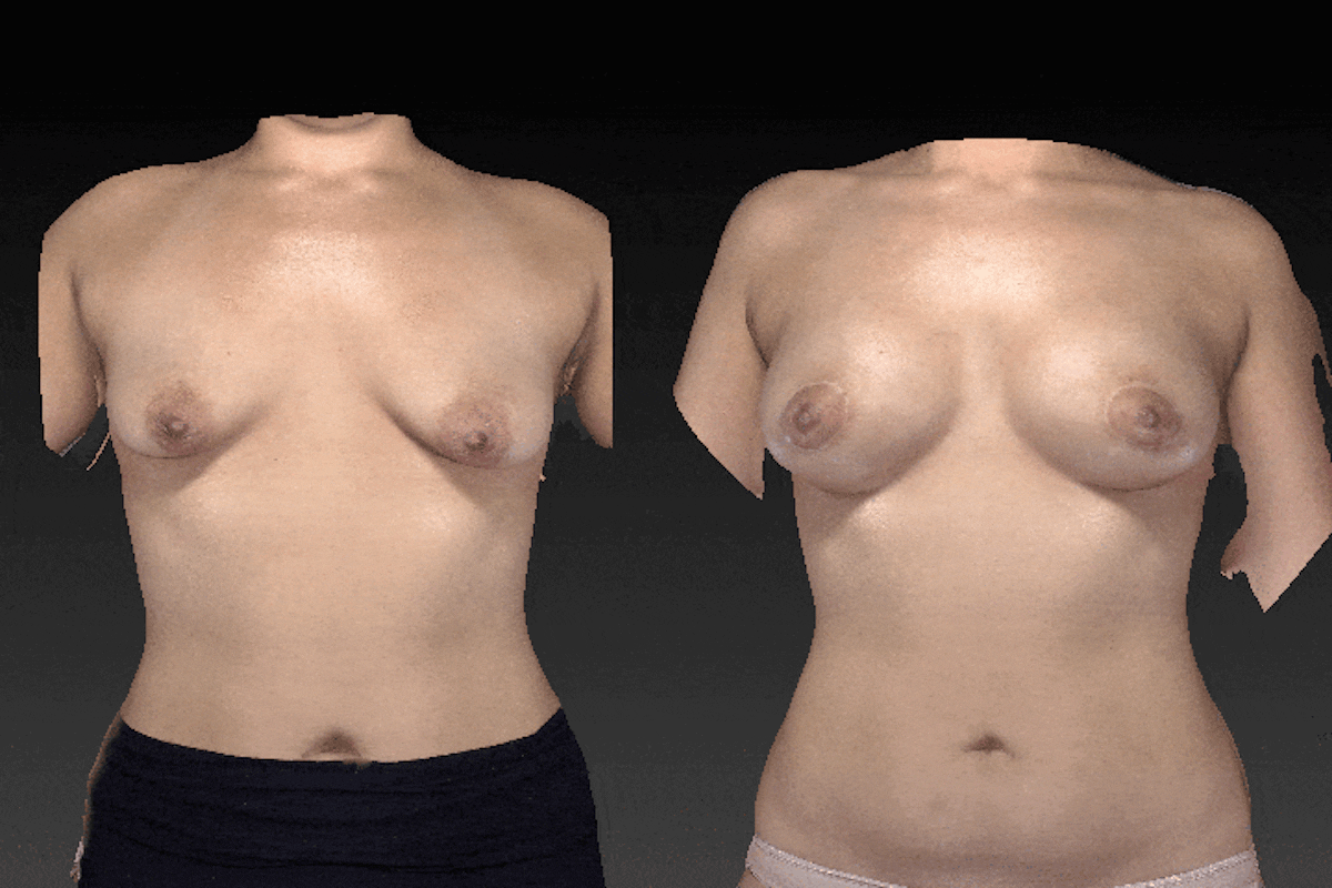 3D Imaging Before & After Gallery - Patient 134859239 - Image 1