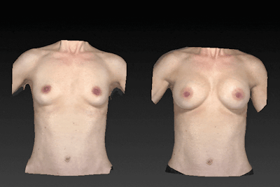 3D Imaging Before & After Gallery - Patient 134859241 - Image 1