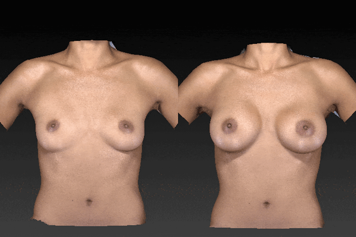 3D Imaging Before & After Gallery - Patient 134859259 - Image 1