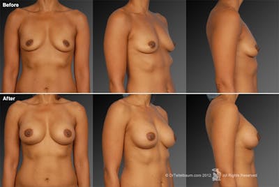 African American Breast Augmentation  Before & After Gallery - Patient 134859243 - Image 1