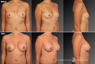 Asian Breast Augmentation Before & After Gallery - Patient 134859249 - Image 1