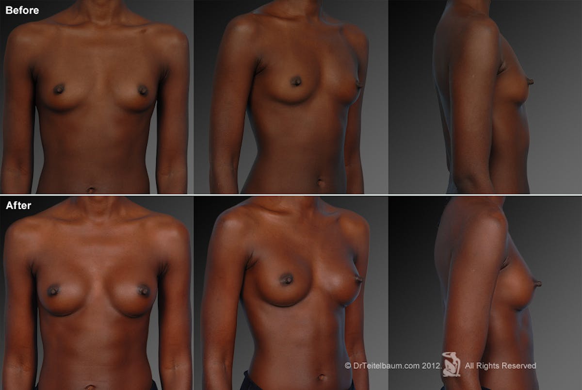 African American Breast Augmentation  Before & After Gallery - Patient 134859250 - Image 1