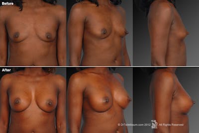 African American Breast Augmentation  Before & After Gallery - Patient 134859253 - Image 1