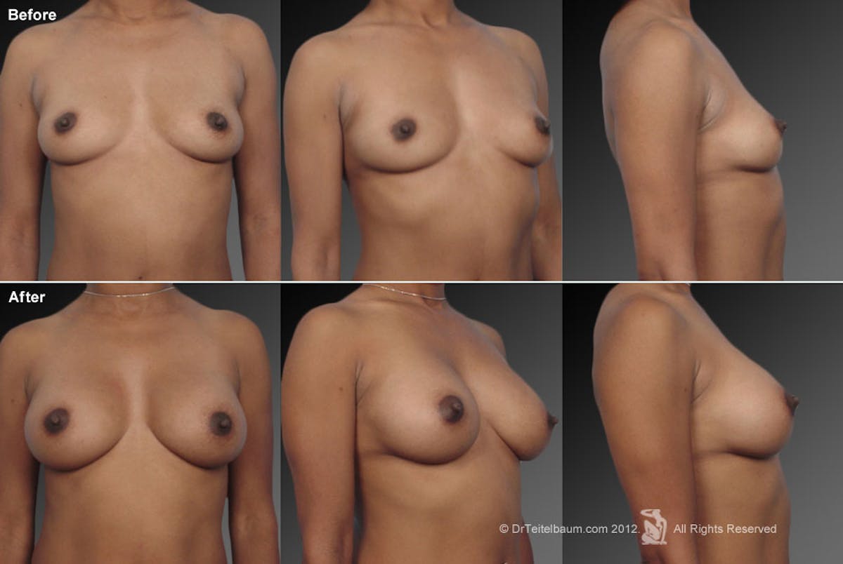 African American Breast Augmentation  Before & After Gallery - Patient 134859257 - Image 1