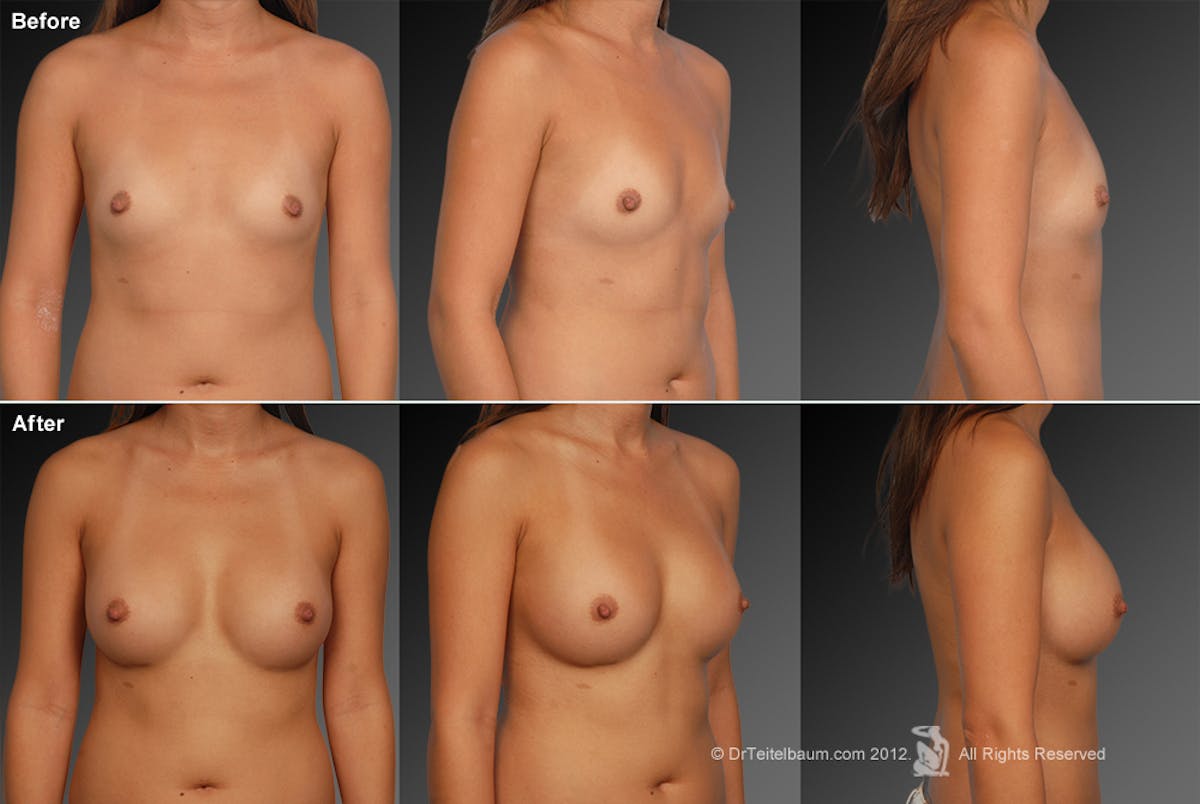 Asian Breast Augmentation Before & After Gallery - Patient 134859261 - Image 1