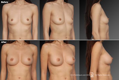 Asian Breast Augmentation Before & After Gallery - Patient 134859263 - Image 1