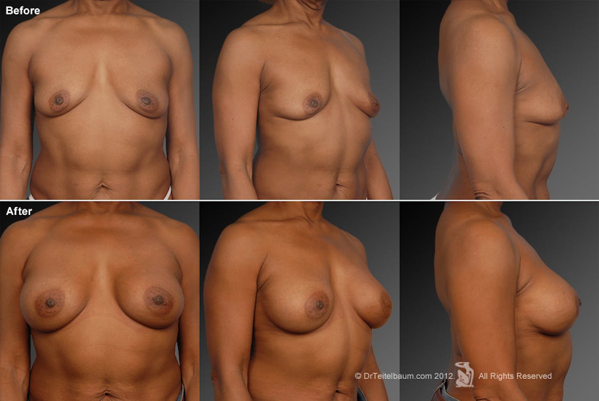 African American Breast Augmentation  Before & After Gallery - Patient 134859265 - Image 1