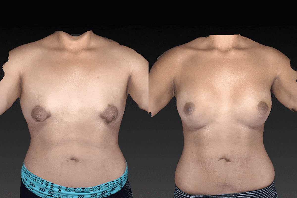 3D Imaging Before & After Gallery - Patient 134859274 - Image 1