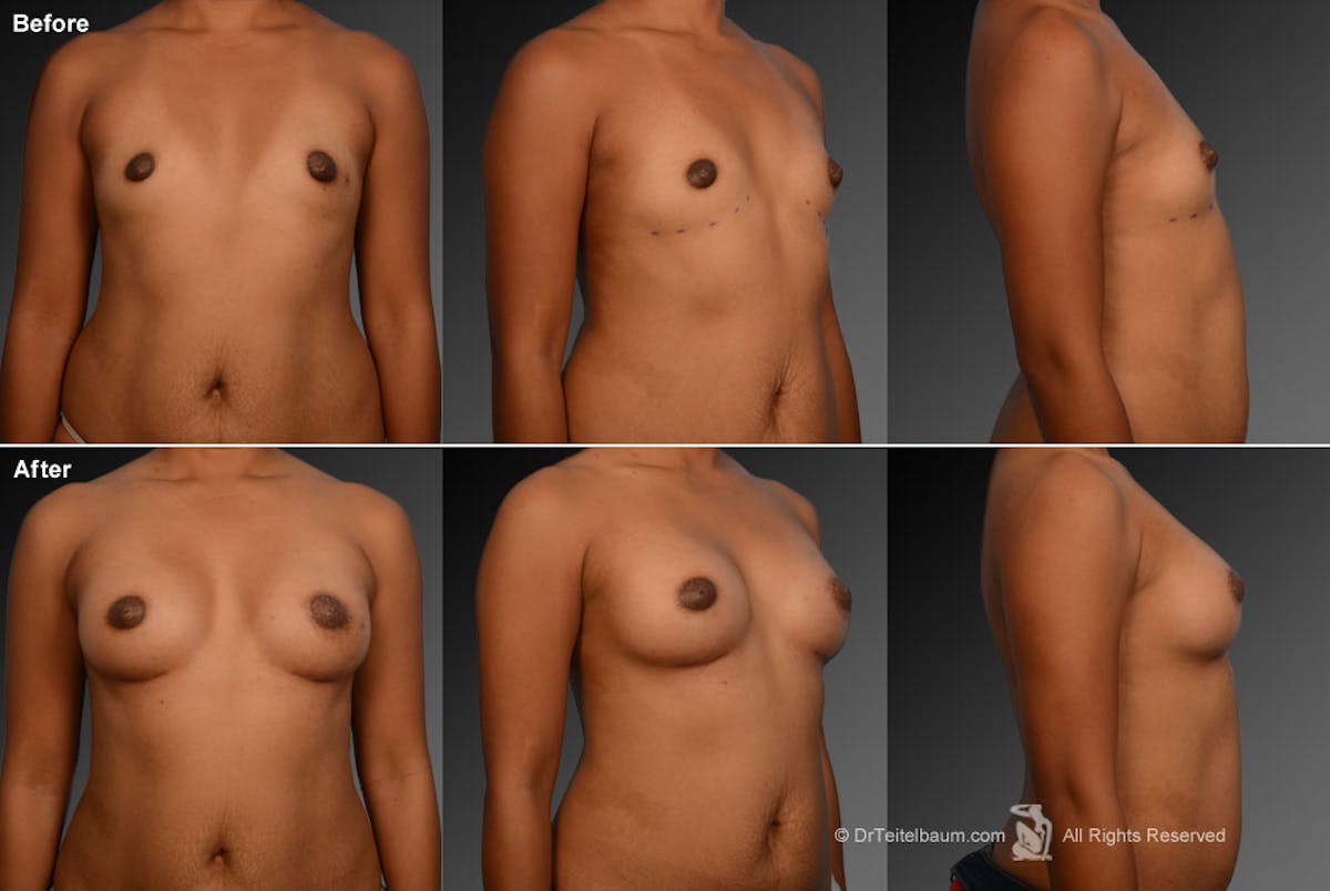 African American Breast Augmentation  Before & After Gallery - Patient 134859268 - Image 1